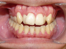 Mikala before Invisalign